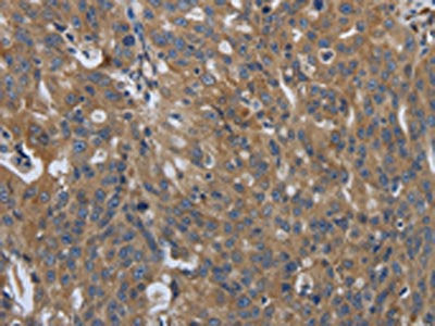 The image on the left is immunohistochemistry of paraffin-embedded Human ovarian cancer tissue using SOCS1 Antibody(SOCS1 Antibody) at dilution 1/90, on the right is treated with synthetic peptide. (Original magnification: ×200)Rabbit anti-Human SOCS1 Polyclonal Antibody