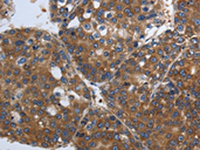 The image on the left is immunohistochemistry of paraffin-embedded Human liver cancer tissue using the antibody Antibody) at dilution 1/90, on the right is treated with synthetic peptide. (Original magnification: ×200)Rabbit anti-Human SOCS1 Polyclonal Antibody