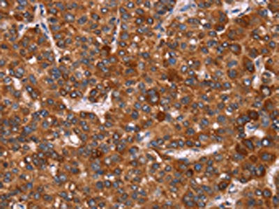 The image on the left is immunohistochemistry of paraffin-embedded Human liver cancer tissue using GAGE12I Antibody(GAGE12I Antibody) at dilution 1/20, on the right is treated with synthetic peptide. (Original magnification: ×200)Rabbit anti-Human GAGE12I Polyclonal Antibody