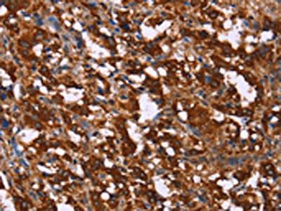 The image on the left is immunohistochemistry of paraffin-embedded Human thyroid cancer tissue using the antibody Antibody) at dilution 1/20, on the right is treated with synthetic peptide. (Original magnification: ×200)Rabbit anti-Human GAGE12I Polyclonal Antibody