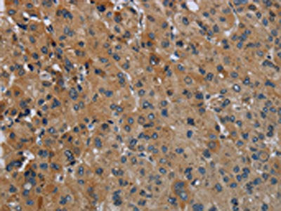 The image on the left is immunohistochemistry of paraffin-embedded Human liver cancer tissue using the antibody Antibody) at dilution 1/50, on the right is treated with fusion protein. (Original magnification: ×200)Rabbit anti-Human FAAH Polyclonal Antibody