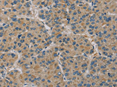 The image on the left is immunohistochemistry of paraffin-embedded Human liver cancer tissue using PAGE2 Antibody(PAGE2 Antibody) at dilution 1/20, on the right is treated with fusion protein. (Original magnification: ×200)Rabbit anti-Human PAGE2 Polyclonal Antibody