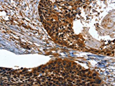 The image on the left is immunohistochemistry of paraffin-embedded Human esophagus cancer tissue using the antibody Antibody) at dilution 1/30, on the right is treated with fusion protein. (Original magnification: ×200)Rabbit anti-Human TWF1 Polyclonal Antibody