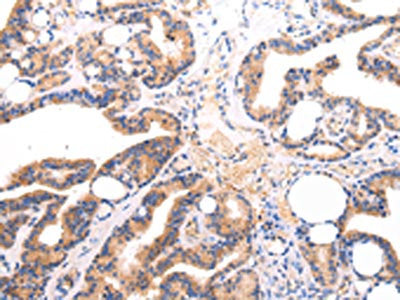 The image on the left is immunohistochemistry of paraffin-embedded Human thyroid cancer tissue using IGLV1-51 Antibody(Lambda Light chain Antibody) at dilution 1/20, on the right is treated with synthetic peptide. (Original magnification: ×200)Rabbit anti-Human IGLV1-51 Polyclonal Antibody