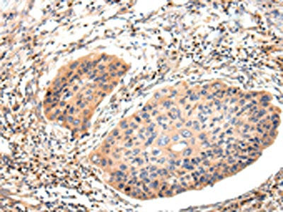 The image on the left is immunohistochemistry of paraffin-embedded Human esophagus cancer tissue using the antibody Light chain Antibody) at dilution 1/20, on the right is treated with synthetic peptide. (Original magnification: ×200)Rabbit anti-Human IGLV1-51 Polyclonal Antibody
