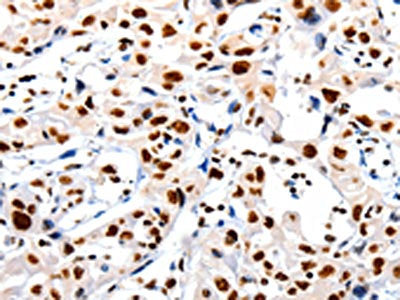 The image on the left is immunohistochemistry of paraffin-embedded Human lung cancer tissue using HDAC1 Antibody(HDAC1 Antibody) at dilution 1/20, on the right is treated with synthetic peptide. (Original magnification: ×200)Rabbit anti-Human HDAC1 Polyclonal Antibody