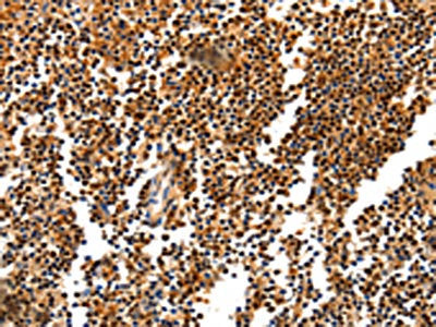 The image on the left is immunohistochemistry of paraffin-embedded Human tonsil tissue using the antibody Antibody) at dilution 1/20, on the right is treated with synthetic peptide. (Original magnification: ×200)Rabbit anti-Human HDAC1 Polyclonal Antibody