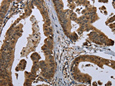 The image on the left is immunohistochemistry of paraffin-embedded Human gastric cancer tissue using GOLGA2 Antibody(GOLGA2 Antibody) at dilution 1/60, on the right is treated with fusion protein. (Original magnification: ×200)Rabbit anti-Human GOLGA2 Polyclonal Antibody