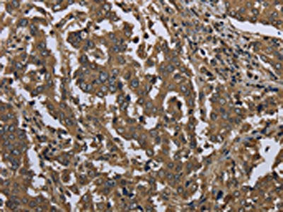 The image on the left is immunohistochemistry of paraffin-embedded Human liver cancer tissue using the antibody Antibody) at dilution 1/60, on the right is treated with fusion protein. (Original magnification: ×200)Rabbit anti-Human GOLGA2 Polyclonal Antibody