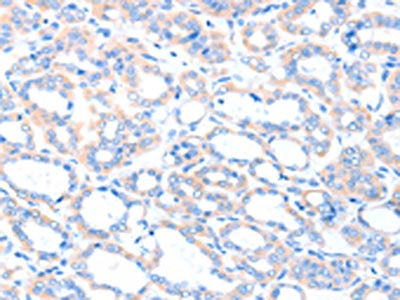The image on the left is immunohistochemistry of paraffin-embedded Human thyroid cancer tissue using the antibody Antibody) at dilution 1/35, on the right is treated with fusion protein. (Original magnification: ×200)