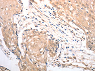 The image on the left is immunohistochemistry of paraffin-embedded Human cervical cancer tissue using RAD52 Antibody(RAD52 Antibody) at dilution 1/25, on the right is treated with synthetic peptide. (Original magnification: ×200)Rabbit anti-Human RAD52 Polyclonal Antibody