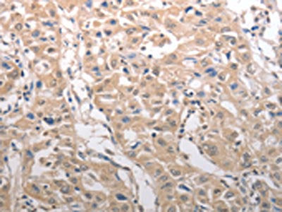 The image on the left is immunohistochemistry of paraffin-embedded Human lung cancer tissue using the antibody Antibody) at dilution 1/25, on the right is treated with synthetic peptide. (Original magnification: ×200)Rabbit anti-Human RAD52 Polyclonal Antibody