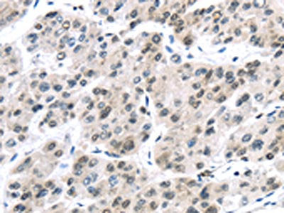 The image on the left is immunohistochemistry of paraffin-embedded Human liver cancer tissue using DDX39B Antibody(DDX39B Antibody) at dilution 1/35, on the right is treated with synthetic peptide. (Original magnification: ×200)Rabbit anti-Human DDX39B Polyclonal Antibody
