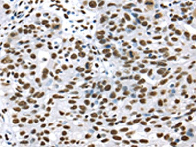 The image on the left is immunohistochemistry of paraffin-embedded Human breast cancer tissue using the antibody Antibody) at dilution 1/35, on the right is treated with synthetic peptide. (Original magnification: ×200)Rabbit anti-Human DDX39B Polyclonal Antibody