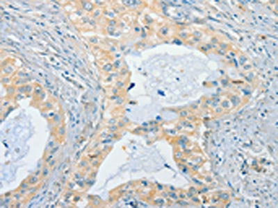 The image on the left is immunohistochemistry of paraffin-embedded Human cervical cancer tissue using the antibody Antibody) at dilution 1/40, on the right is treated with synthetic peptide. (Original magnification: ×200)Rabbit anti-Human CHRNA2 Polyclonal Antibody