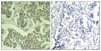Immunohistochemical analysis of paraffin-embedded human breast carcinoma tissue using eIF2α (Phospho-Ser49) Antibody (left) or the same antibody preincubated with blocking peptide (right).Rabbit anti-Human EIF2S1 Polyclonal Antibody