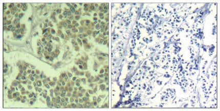 Immunohistochemical analysis of paraffin-embedded human breast carcinoma tissue using eIF2α (Phospho-Ser49) Antibody (left) or the same antibody preincubated with blocking peptide (right).Rabbit anti-Human EIF2S1 Polyclonal Antibody