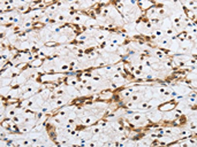The image on the left is immunohistochemistry of paraffin-embedded Human renal cancer tissue using POU2F2 Antibody(POU2F2 Antibody) at dilution 1/40, on the right is treated with fusion protein. (Original magnification: ×200)