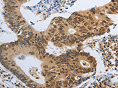 The image on the left is immunohistochemistry of paraffin-embedded Human colon cancer tissue using the antibody Antibody) at dilution 1/40, on the right is treated with fusion protein. (Original magnification: ×200)