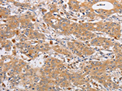 The image on the left is immunohistochemistry of paraffin-embedded Human gastric cancer tissue using OLR1 Antibody(OLR1 Antibody) at dilution 1/50, on the right is treated with fusion protein. (Original magnification: ×200)Rabbit anti-Human OLR1 Polyclonal Antibody