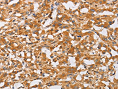 The image on the left is immunohistochemistry of paraffin-embedded Human thyroid cancer tissue using the antibody Antibody) at dilution 1/50, on the right is treated with fusion protein. (Original magnification: ×200)Rabbit anti-Human OLR1 Polyclonal Antibody