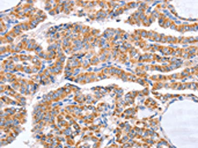 The image on the left is immunohistochemistry of paraffin-embedded Human thyroid cancer tissue using B3GAT1 Antibody(B3GAT1 Antibody) at dilution 1/50, on the right is treated with synthetic peptide. (Original magnification: ×200)
