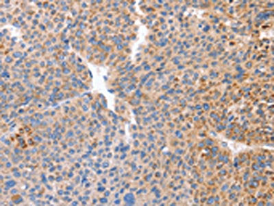The image on the left is immunohistochemistry of paraffin-embedded Human liver cancer tissue using the antibody Antibody) at dilution 1/50, on the right is treated with synthetic peptide. (Original magnification: ×200)