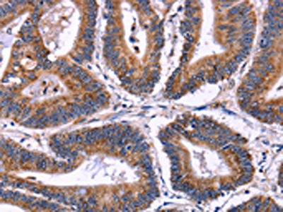 The image on the left is immunohistochemistry of paraffin-embedded Human colon cancer tissue using SIGLEC5 Antibody(SIGLEC5 Antibody) at dilution 1/30, on the right is treated with fusion protein. (Original magnification: ×200)Rabbit anti-Human SIGLEC5 Polyclonal Antibody