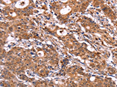 The image on the left is immunohistochemistry of paraffin-embedded Human gastic cancer tissue using the antibody Antibody) at dilution 1/30, on the right is treated with fusion protein. (Original magnification: ×200)Rabbit anti-Human SIGLEC5 Polyclonal Antibody