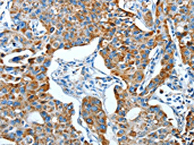 The image on the left is immunohistochemistry of paraffin-embedded Human lung cancer tissue using ALDH6A1 Antibody(ALDH6A1 Antibody) at dilution 1/45, on the right is treated with fusion protein. (Original magnification: ×200)Rabbit anti-Human ALDH6A1 Polyclonal Antibody