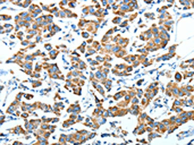 The image on the left is immunohistochemistry of paraffin-embedded Human breast cancer tissue using the antibody Antibody) at dilution 1/45, on the right is treated with fusion protein. (Original magnification: ×200)Rabbit anti-Human ALDH6A1 Polyclonal Antibody