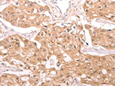 The image on the left is immunohistochemistry of paraffin-embedded Human breast cancer tissue using TXN Antibody(TXN Antibody) at dilution 1/20, on the right is treated with synthetic peptide. (Original magnification: ×200)Rabbit anti-Human TXN Polyclonal Antibody