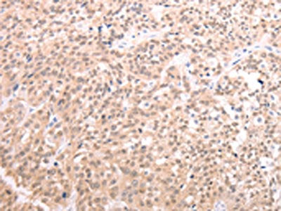 The image on the left is immunohistochemistry of paraffin-embedded Human esophagus cancer tissue using the antibody Antibody) at dilution 1/20, on the right is treated with synthetic peptide. (Original magnification: ×200)Rabbit anti-Human TXN Polyclonal Antibody