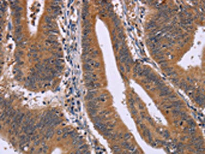 The image on the left is immunohistochemistry of paraffin-embedded Human colon cancer tissue using CMTM6 Antibody(CMTM6 Antibody) at dilution 1/30, on the right is treated with synthetic peptide. (Original magnification: ×200)Rabbit anti-Human CMTM6 Polyclonal Antibody