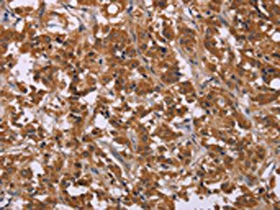 The image on the left is immunohistochemistry of paraffin-embedded Human thyroid cancer tissue using the antibody Antibody) at dilution 1/30, on the right is treated with synthetic peptide. (Original magnification: ×200)Rabbit anti-Human CMTM6 Polyclonal Antibody