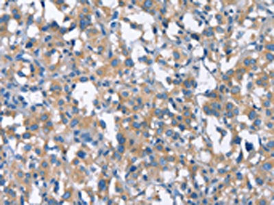 The image on the left is immunohistochemistry of paraffin-embedded Human thyroid cancer tissue using CDC25A Antibody(CDC25A Antibody) at dilution 1/50, on the right is treated with synthetic peptide. (Original magnification: ×200)Rabbit anti-Human CDC25A Polyclonal Antibody