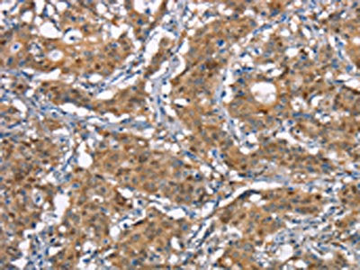 The image on the left is immunohistochemistry of paraffin-embedded Human gastic cancer tissue using the antibody Antibody) at dilution 1/50, on the right is treated with synthetic peptide. (Original magnification: ×200)Rabbit anti-Human CDC25A Polyclonal Antibody