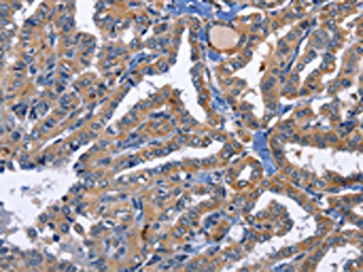 The image on the left is immunohistochemistry of paraffin-embedded Human thyroid cancer tissue using PRKCD Antibody(PRKCD Antibody) at dilution 1/30, on the right is treated with fusion protein. (Original magnification: ×200)Rabbit anti-Human PRKCD Polyclonal Antibody