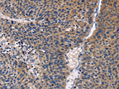 The image on the left is immunohistochemistry of paraffin-embedded Human liver cancer tissue using the antibody Antibody) at dilution 1/30, on the right is treated with fusion protein. (Original magnification: ×200)Rabbit anti-Human PRKCD Polyclonal Antibody