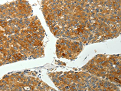 The image on the left is immunohistochemistry of paraffin-embedded Human liver cancer tissue using PTPN6 Antibody(PTPN6 Antibody) at dilution 1/35, on the right is treated with fusion protein. (Original magnification: ×200)Rabbit anti-Human PTPN6 Polyclonal Antibody