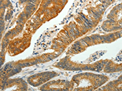 The image on the left is immunohistochemistry of paraffin-embedded Human colon cancer tissue using the antibody Antibody) at dilution 1/35, on the right is treated with fusion protein. (Original magnification: ×200)Rabbit anti-Human PTPN6 Polyclonal Antibody