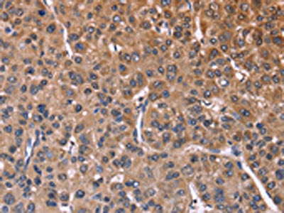 The image on the left is immunohistochemistry of paraffin-embedded Human liver cancer tissue using SEPT7 Antibody(SEPT7 Antibody) at dilution 1/60, on the right is treated with fusion protein. (Original magnification: ×200)Rabbit anti-Human SEPT7 Polyclonal Antibody