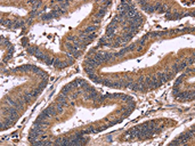 The image on the left is immunohistochemistry of paraffin-embedded Human colon cancer tissue using the antibody Antibody) at dilution 1/60, on the right is treated with fusion protein. (Original magnification: ×200)Rabbit anti-Human SEPT7 Polyclonal Antibody