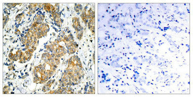 Immunohistochemical analysis of paraffin-embedded human breast carcinoma tissue using GSK3a(Ab-21) Antibody(left) or the same antibody preincubated with blocking peptide(right).Rabbit anti-Human GSK3A Polyclonal Antibody