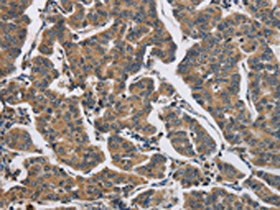 The image on the left is immunohistochemistry of paraffin-embedded Human breast cancer tissue using the antibody Antibody) at dilution 1/30, on the right is treated with fusion protein. (Original magnification: ×200)Rabbit anti-Human DHRS3 Polyclonal Antibody