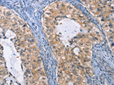 The image on the left is immunohistochemistry of paraffin-embedded Human cervical cancer tissue using IRF3 Antibody(IRF3 Antibody) at dilution 1/30, on the right is treated with fusion protein. (Original magnification: ×200)