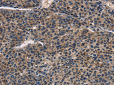 The image on the left is immunohistochemistry of paraffin-embedded Human liver cancer tissue using the antibody Antibody) at dilution 1/30, on the right is treated with fusion protein. (Original magnification: ×200)