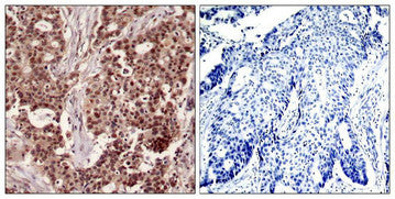 Immunohistochemical analysis of paraffin-embedded human breast carcinoma tissue using NFkB-p105(Phospho-Ser927) Antibody(left) or the same antibody preincubated with blocking peptide(right).Rabbit anti-Human NFKB1 Polyclonal Antibody