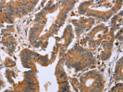 The image on the left is immunohistochemistry of paraffin-embedded Human colon cancer tissue using the antibody Antibody) at dilution 1/20, on the right is treated with fusion protein. (Original magnification: ×200)Rabbit anti-Human EPDR1 Polyclonal Antibody