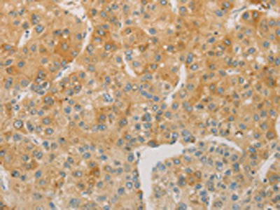 The image on the left is immunohistochemistry of paraffin-embedded Human liver cancer tissue using the antibody Antibody) at dilution 1/60, on the right is treated with fusion protein. (Original magnification: ×200)